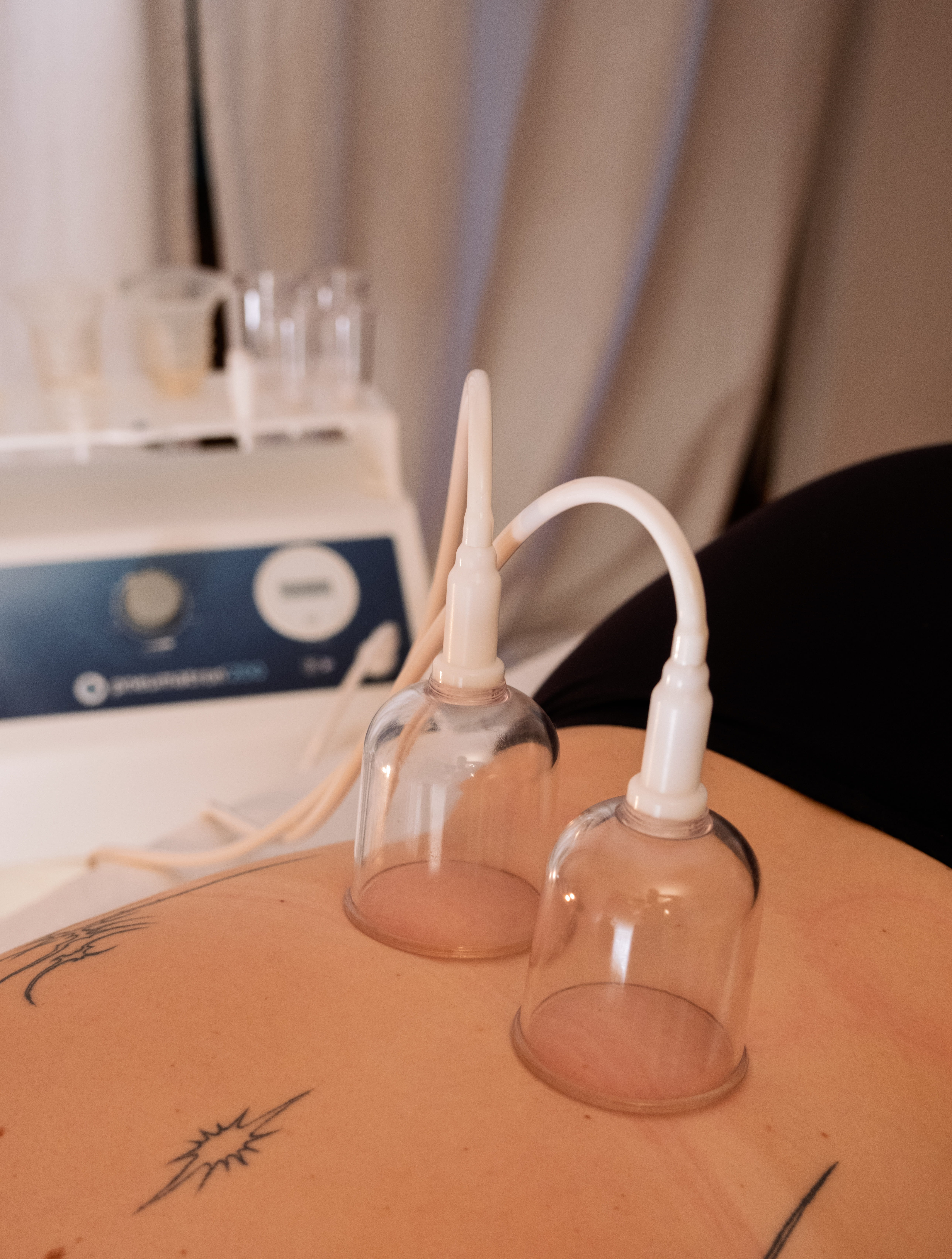 Triggerpunktmassage – Pneumatron®200 im Einsatz